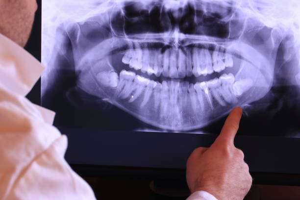 Best Emergency Wisdom Tooth Extraction in Armonk, NY