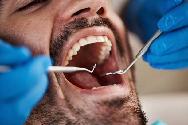 Best Knocked-Out Tooth (Avulsed Tooth) Treatment in Armonk, NY